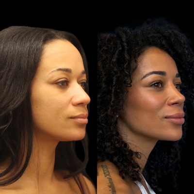 25-34 year old woman treated with African American Rhinoplasty, Rhinoplasty - Before & after rhinoplasty: dorsal hump removal and tip refinement for a balanced, natural profile.