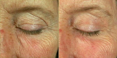 Woman treated with Pearl Laser - Pearl Laser