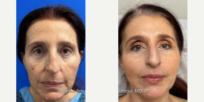 Woman treated with TCA Peel - Fat Transfer to Face, TCA Peel Fat transfer to face, also called fat grafting and lipo filling, is a procedure that uses a persons own fat to fill in irregularities & grooves. A TCA Peel is a (Trichloroacetic Acid) medium to deep non-invasive skin treatment to treat skin discolorations, scarring, and wrinkles. Physicians use 35% medical grade, and can sometimes be performed with local, twilight and/or general anesthesia. This patient is in her late 50s and is 1 month post-op (she still has little brownish areas on the sides & around the eyes) that will soon come off. When all the skin is peeled off, it exposes a new layer of undamaged skin, which has a smoother texture and a more even color.