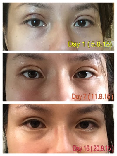 Taiwan eyelid outlet surgery