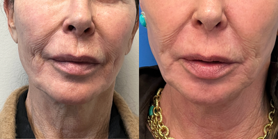 65-74 year old woman treated with Laser Resurfacing, BroadBand Light (BBL) - This patient underwent a laser resurfacing procedure in the OR and has continued consisted BBL treatments to improve the initial results.