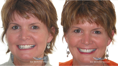 Six Month Smile/ Short term orthodontics - This patient was concerned with crowded teeth. She was affraid to have traditional braces as a child due to the length of the treatment time (Almost 3 years). She opted for the short term ortho to correct her smile. She only needed 5 months in her braces to accomplish her goals.