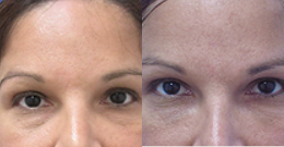 45-54 year old woman treated with Belotero - Lower eyelid/tear through deformity correction. Patient thought her lower eyes make her look tired when she was not.