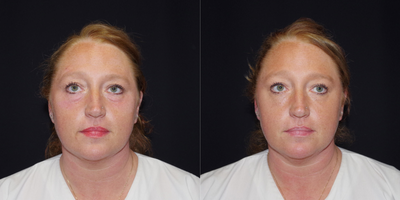 35-44 year old woman treated with Restylane Silk - 44 year old female received 2 syringes of Restylane Silk under the eyes; photos depict the patient's results 3 weeks post-treatment.