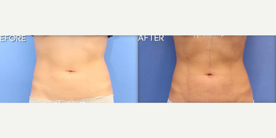 Woman treated with Abdominal Etching - Woman treated with Abdominal Etching, shown one month post op.
