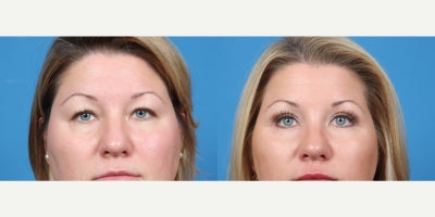 35-44 year old woman treated with Double Eyelid Surgery - Double blepharoplasty