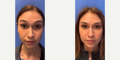 Woman treated with Botox - Woman treated with Botox