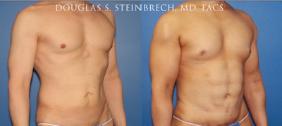Man treated with Bicep Implants - Man treated with Bicep Implants