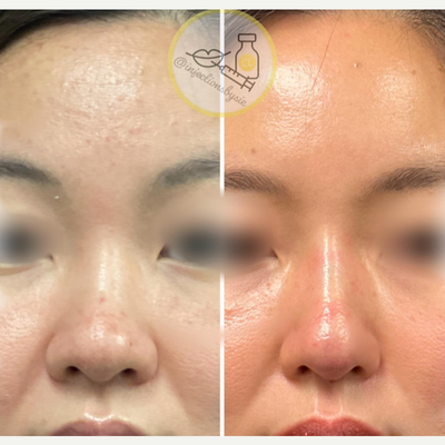 25-34 year old woman treated with Thread Lift, NovaThreads - PDO threads for support definition. This is a great procedure for those who dont want HA filler. Procedure: PDO threads