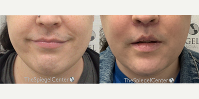 25-34 year old woman treated with Jaw Reduction - Mandible contouring