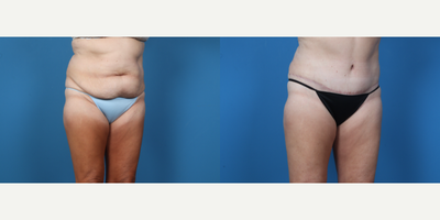 55-64 year old woman treated with Tummy Tuck, Liposuction - Abdominoplasty with suction assisted lipectomy of bilateral hips.