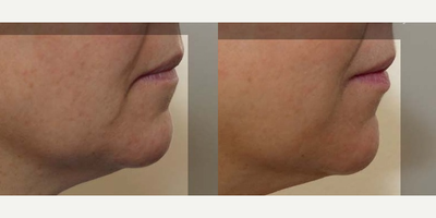 44 year old woman treated with Silhouette InstaLift - 44 year old female 3 months following Silhouette InstaLift