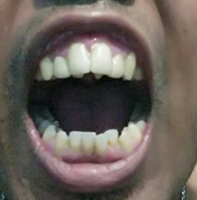 After the treatment of my two front teeth, is the final result normal