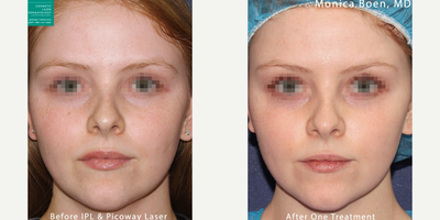 Woman treated with PicoWay - Woman treated with PicoWay
