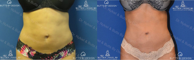 Woman treated with Liposuction Revision - Woman treated with Liposuction Revision