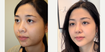 25-34 year old woman treated with Cheekbone Reduction, Genioplasty, Buccal Fat Removal, Jaw Reduction - Facial contouring surgery with combination of several beautifying procedures.
