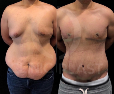Body Lift before and after photo