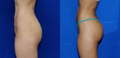Butt Implants before and after photo
