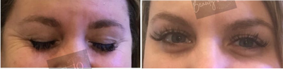 Dysport before and after photo