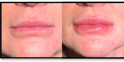 Lip Fillers before and after photo