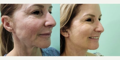 Neck Lift before and after photo