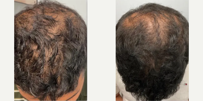 PRP Injections before and after photo