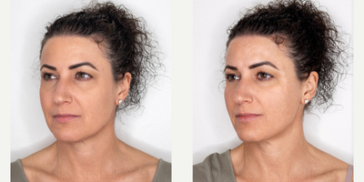 Cheek Fillers before and after photo
