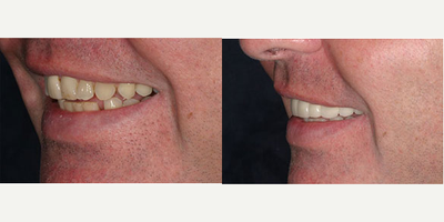 Dental Crown before and after photo