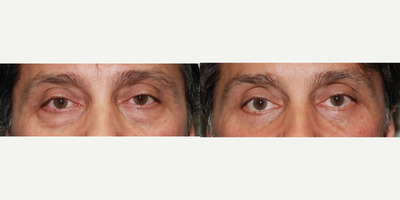 Eyelid Surgery before and after photo