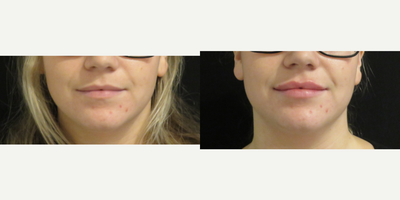 Lip Fillers before and after photo