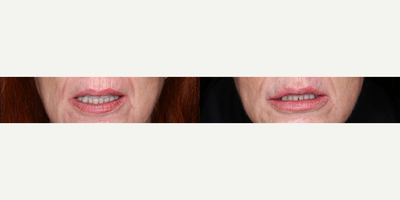 Restylane Silk before and after photo