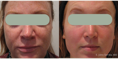 Sculptra before and after photo