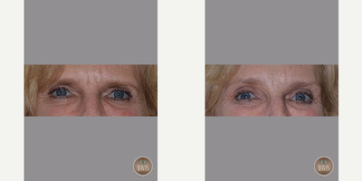 Eyelid Surgery before and after photo