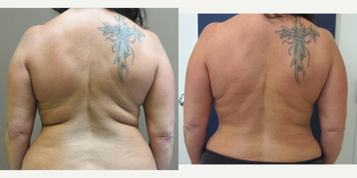 Liposuction before and after photo