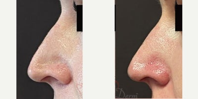Nonsurgical Nose Job before and after photo