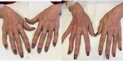Radiesse before and after photo