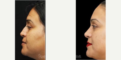 Rhinoplasty before and after photo