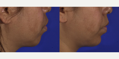 Botox before and after photo