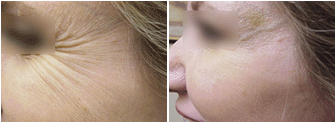 Botox before and after photo