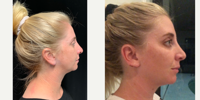 Chin Liposuction before and after photo