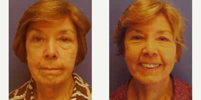 Facelift before and after photo