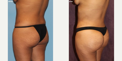 Brazilian Butt Lift before and after photo