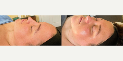 Facial before and after photo