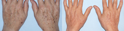IPL before and after photo