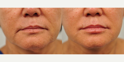 Lip Lift before and after photo