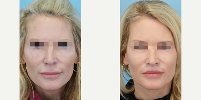 Lip Lift before and after photo