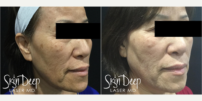 PicoSure before and after photo