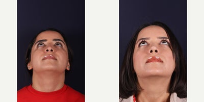 Rhinoplasty before and after photo