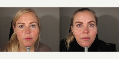 Brow Lift before and after photo