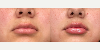 Dermal Fillers before and after photo